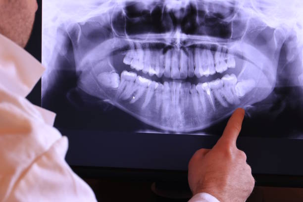 Best Emergency Dentist for Lost Fillings or Crowns in East Liverpool, OH